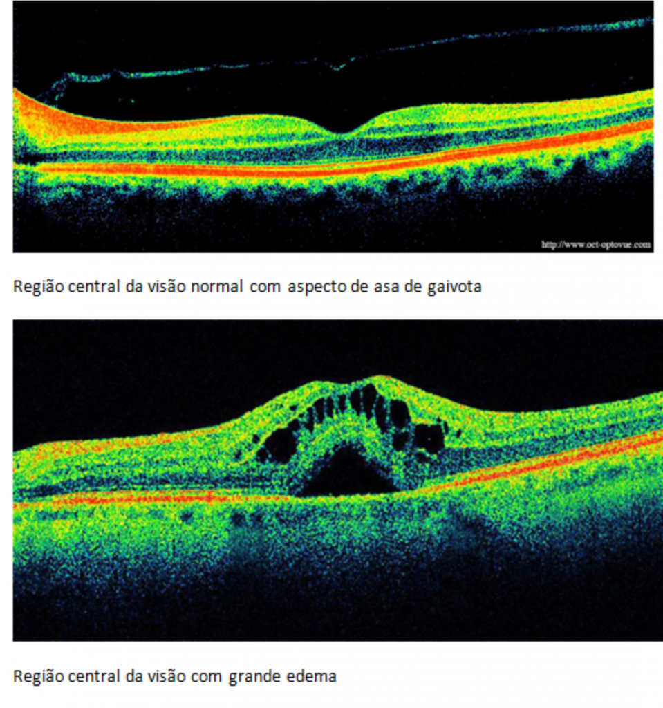 tomografia retina
